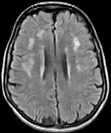 Isquémica pequeños mayo de clínica enfermedad del vasos cerebro